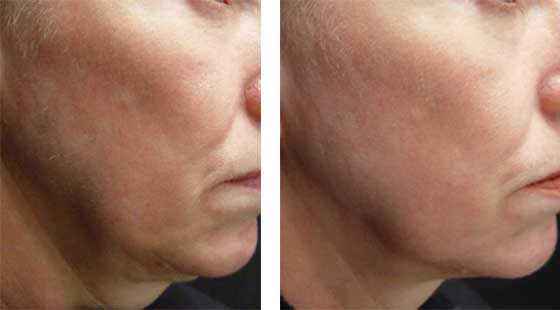 Laser Skin Tightening